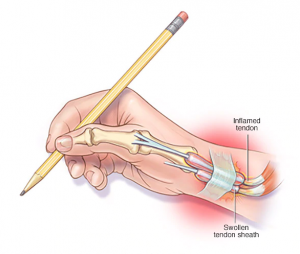 De Quervain’s Tenosynovitis