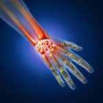 Carpel Tunnel Syndrome